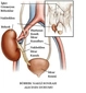 Tek Böbrekle Yaşamak Tek Böbrekle Yaşayabilir miyiz?