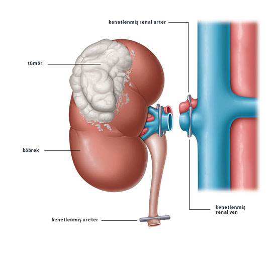 Bbrek st Bezi Kanseri
