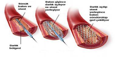 Bbreklere Stent Taklmas