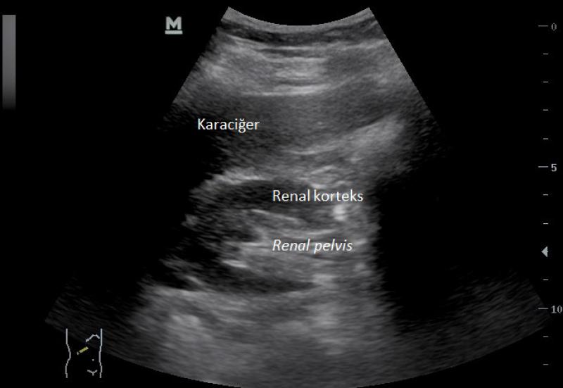 Renal Pelvis Nedir